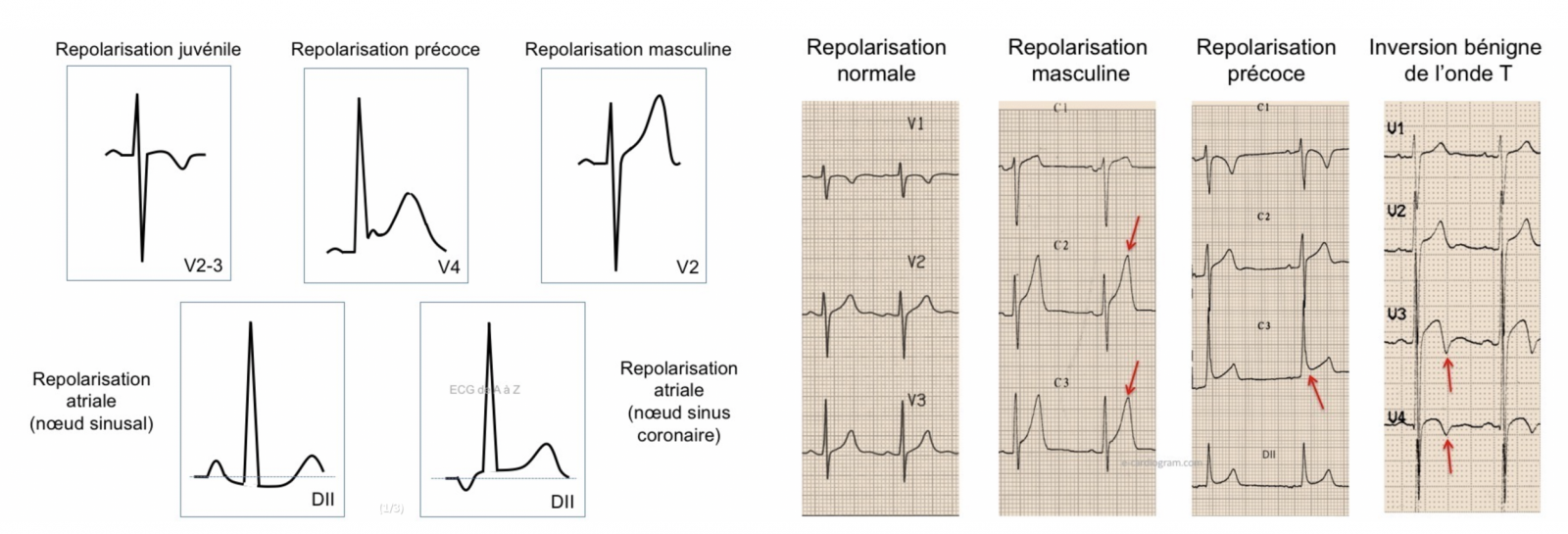 Lexipatho Lectrocardiogramme Ecg Indications Et Interpr Tations